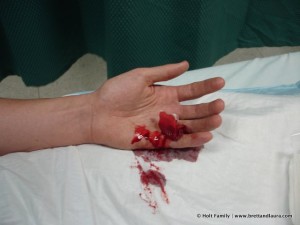 Sliced finger